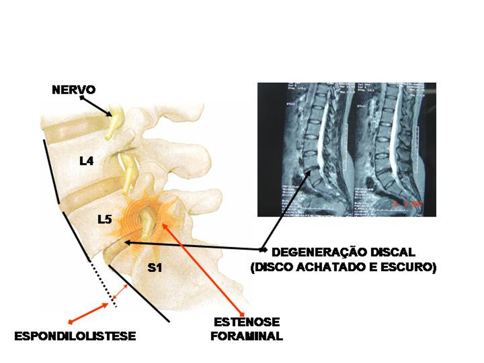 instabilidade-vertebral