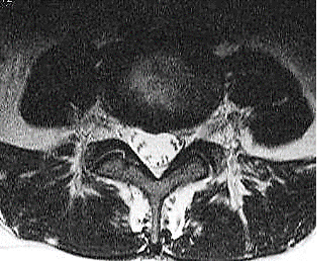 Ressonância Magnética: Hérnia discal protrusa 